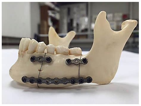 can you box with metal plates in jaw|titanium plates in jaw.